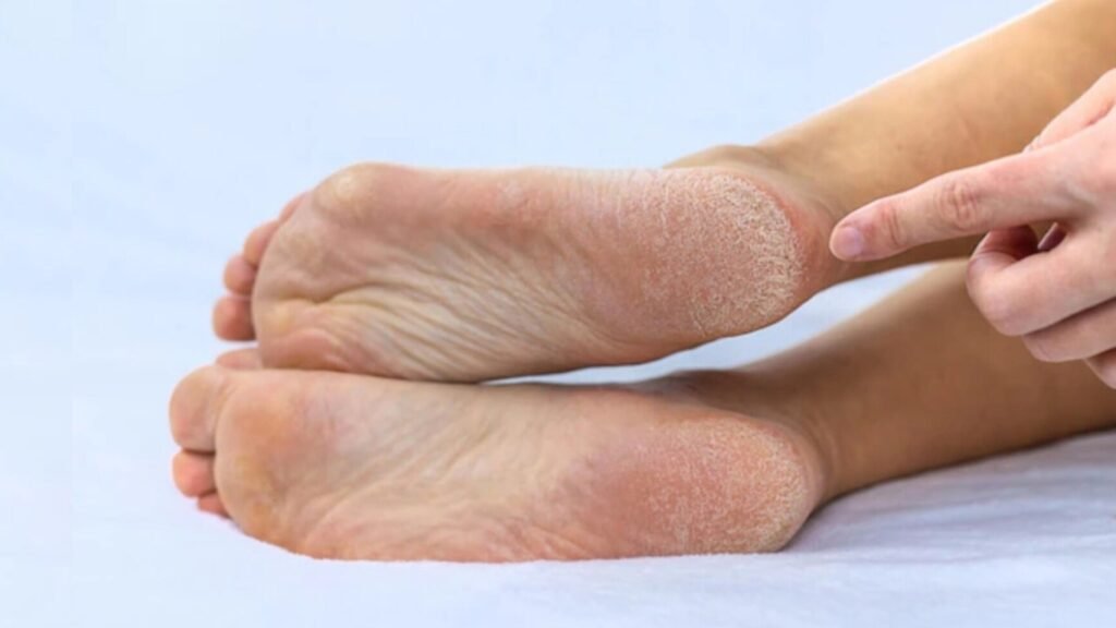 Tratamento caseiro para pés rachados: confira 6 receitas