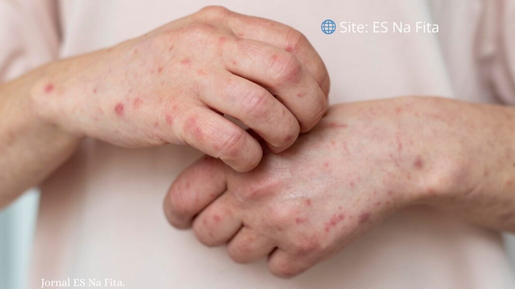 Espírito Santo registra primeiro caso de Mpox em 2026.